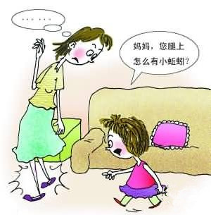 女性高发静脉曲张该怎么办