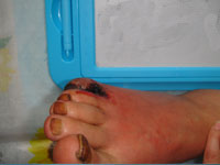 糖尿病足的表现及危害