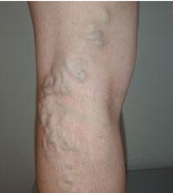 静脉曲张有哪些症状?