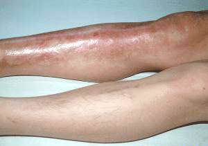 走路腿疼是动脉硬化的前兆