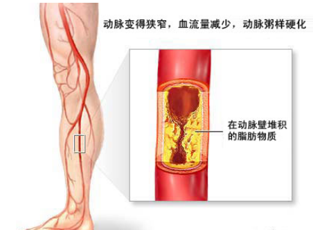 动脉硬化的病因
