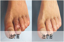 脉管炎能治好吗?