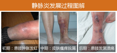 静脉炎怎么治疗有效果？