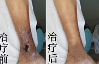 静脉炎能治好吗?