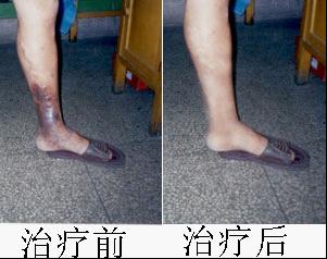 治疗静脉炎需要多少钱？