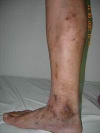 医生详解：静脉炎的危害