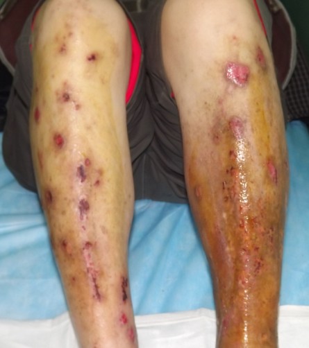 静脉炎的危害你了解多少?