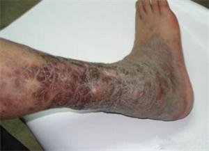 深静脉血栓有哪些危害?