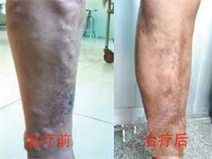 深静脉血栓有哪些危害?