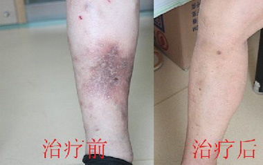 深静脉血栓应如何保养?