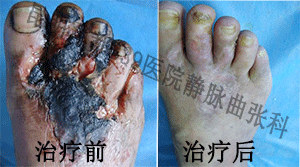 云南李先生脉管炎的康复病历