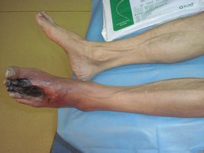 王先生动脉硬化的康复之路