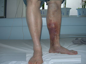 静脉炎患者周先生 回顾昆明三一一康复历程