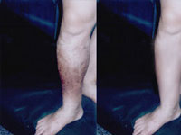 动脉硬化闭塞症患者康复出院