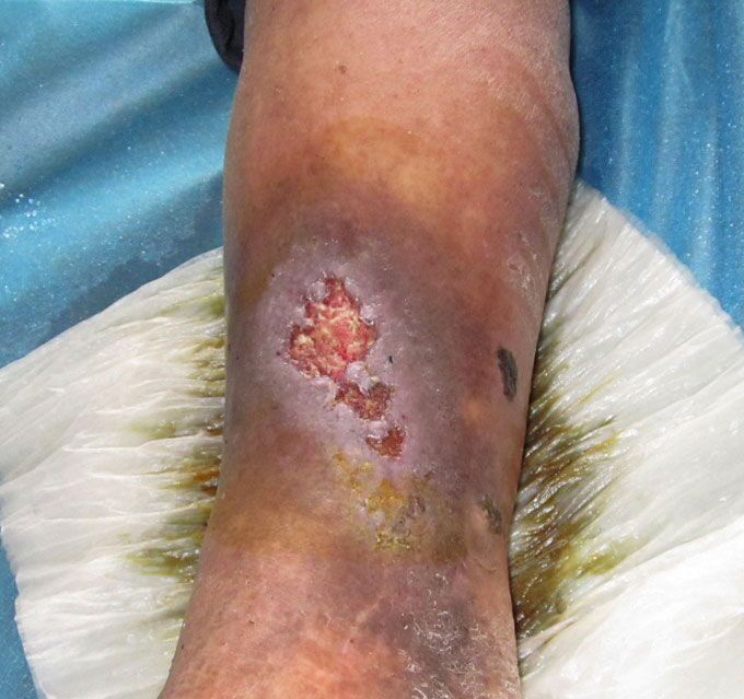医生详解：老烂腿