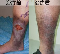 医生详解：老烂腿