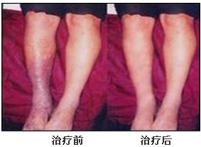 治疗老烂腿，选对方法省钱更省心