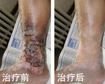 预防老烂腿应怎样做?