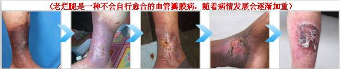 老烂腿临床六期的症状