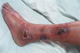 脉管炎和老烂腿的区别