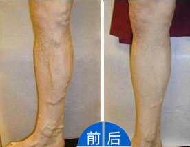静脉曲张临床六大症状