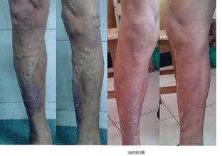 静脉炎在生活中该如何预防