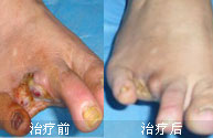 警惕脉管炎吞噬你的双腿