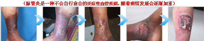 警惕脉管炎吞噬你的双腿