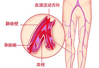 静脉炎与静脉血栓的区别