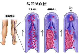 医生解析：静脉血栓的危害