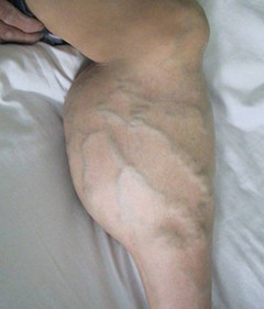 得了静脉曲张会断腿截肢吗?