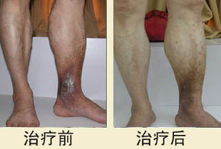 昆明治疗脉管炎怎么做?