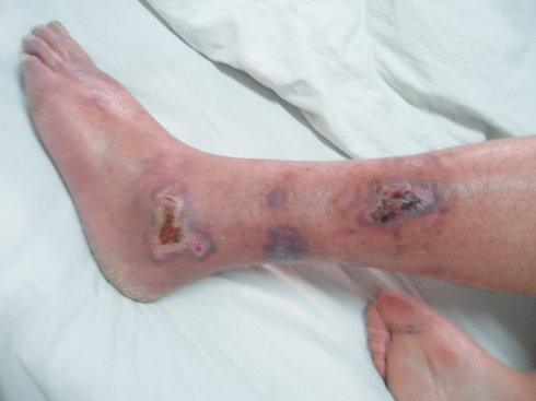 下肢静脉炎临床表现