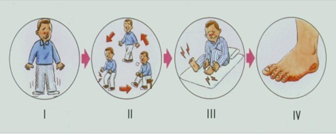走路腿疼是动脉硬化闭塞症的前兆