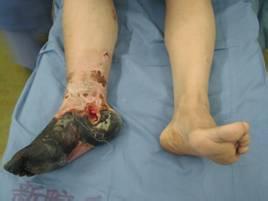 如何更早的发现动脉硬化闭塞症？