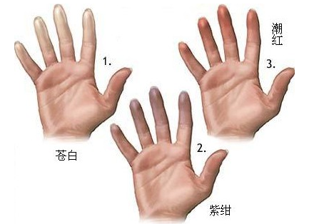 女人，谨防雷诺氏病