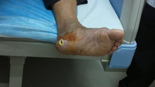 糖尿病足前期脚会痒吗？