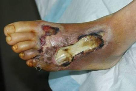 糖尿病足临床特征