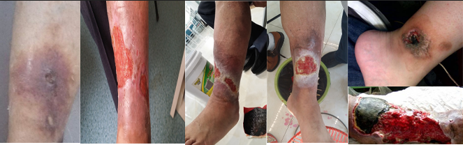 老烂腿会出现那些症状