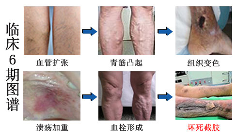 昆明治疗静脉曲张那种方法好