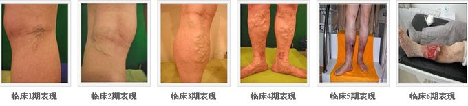 昆明治疗静脉血栓好的医院