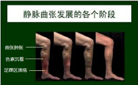 秋季静脉曲张如何预防