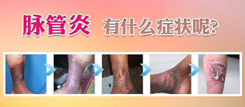 昆明脉管炎治疗医院