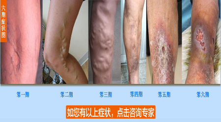 早期脉管炎的症状