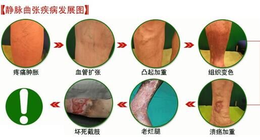 静脉曲张的症状