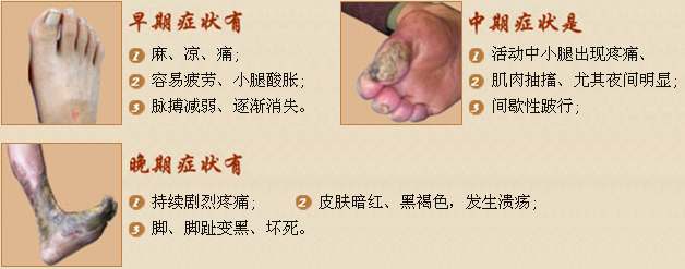 动脉硬化的治疗