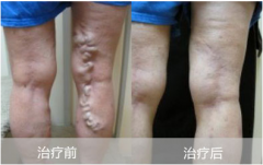 静脉曲张是一种什么样的疾病？