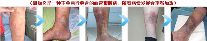 男性静脉炎的早期症状有什么