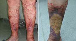 皮肤溃疡坏死,静脉曲张正在侵蚀你的健康