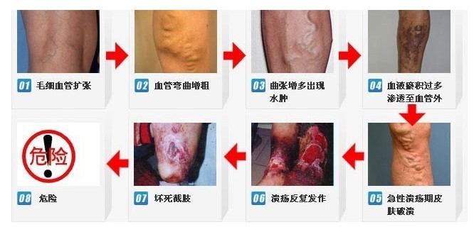 静脉曲张危害巨大，了解症状及时治疗是关键！